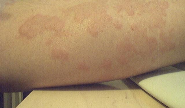 Sezonowe Alergie: Jak Rozpoznać Objawy